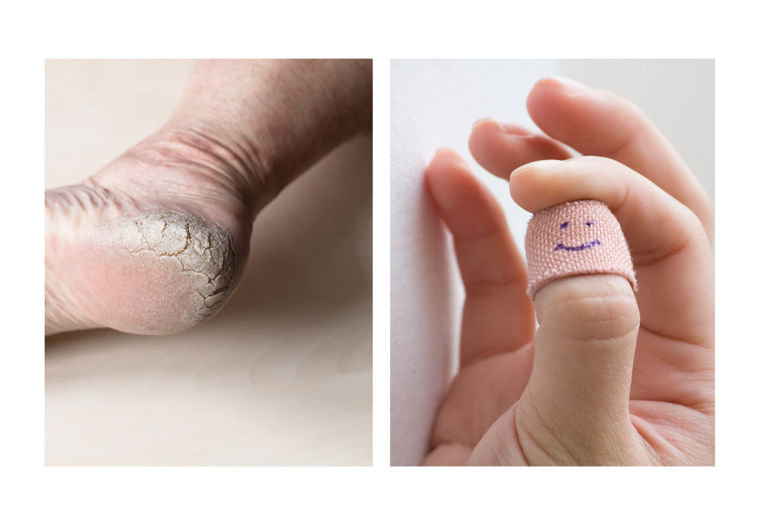 cracked heel and bandage on finger
