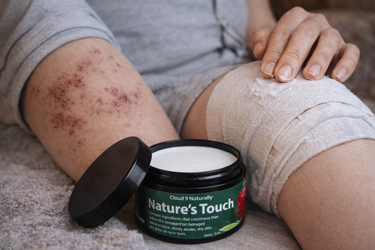 Nature's Touch – Skin Relief for Shingles Damage