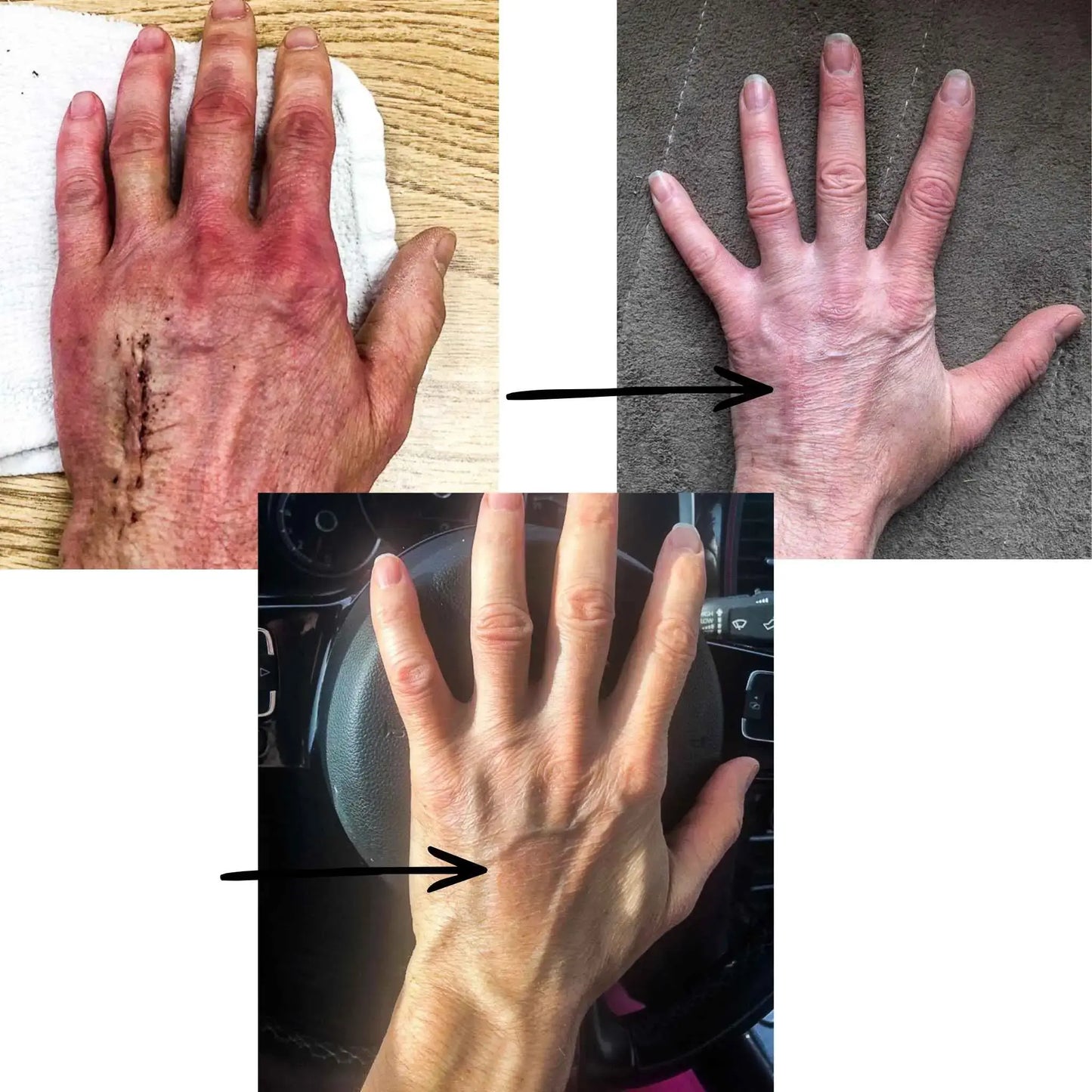 Collage of 3 images showing different views of a hand with visible injuries and aging.